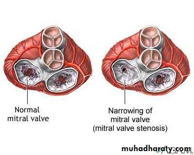 Valvular heart diseases