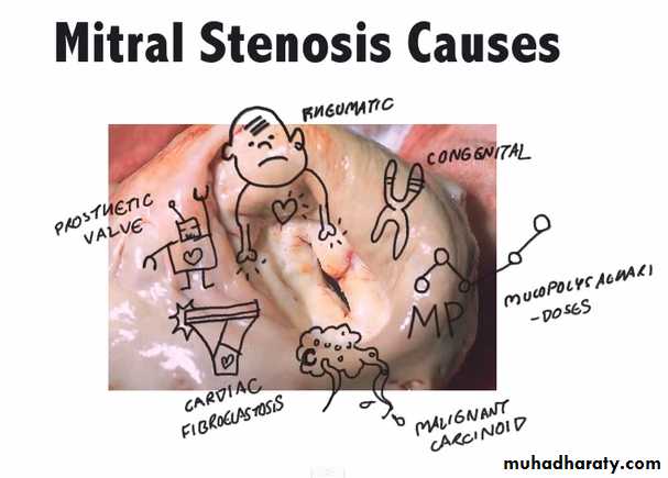 Valvular heart diseases