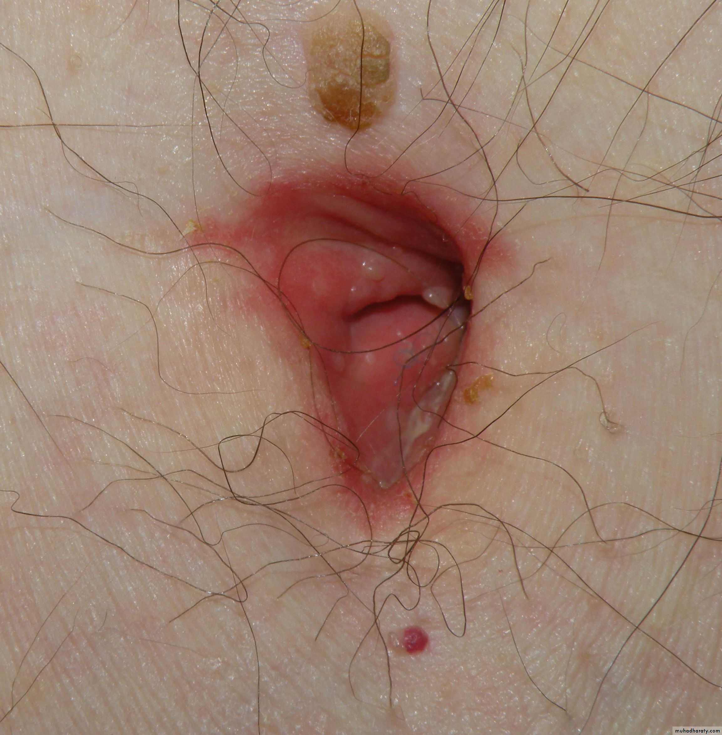 Spigelian hernia