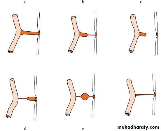 Spigelian hernia