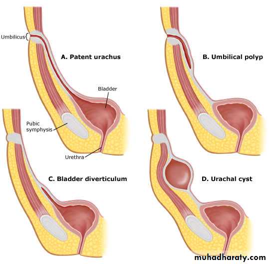 Spigelian hernia