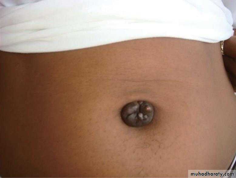 Spigelian hernia