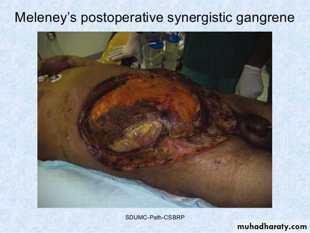 Spigelian hernia