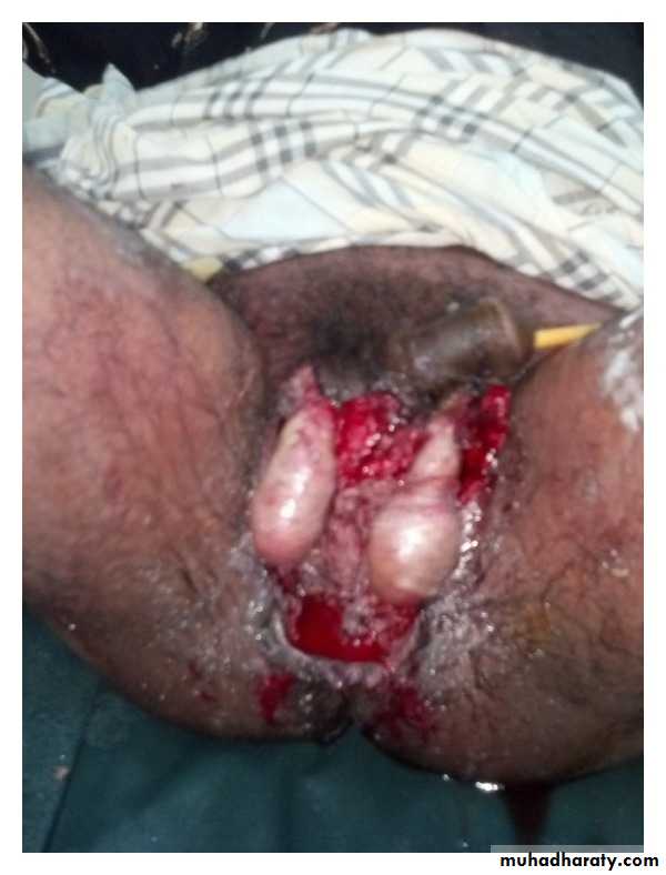 Spigelian hernia