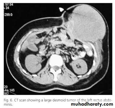Spigelian hernia