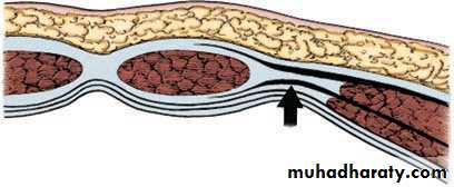 Spigelian hernia