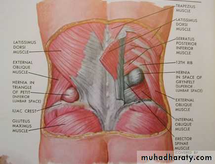 Spigelian hernia