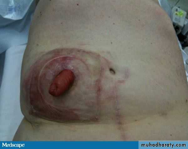 Spigelian hernia