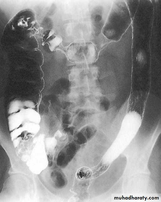 Small and large intestines