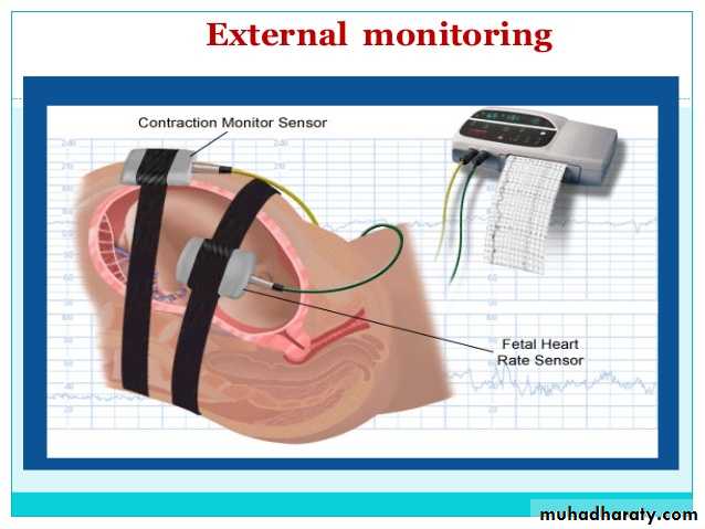 Intrapartum fetal monitoring