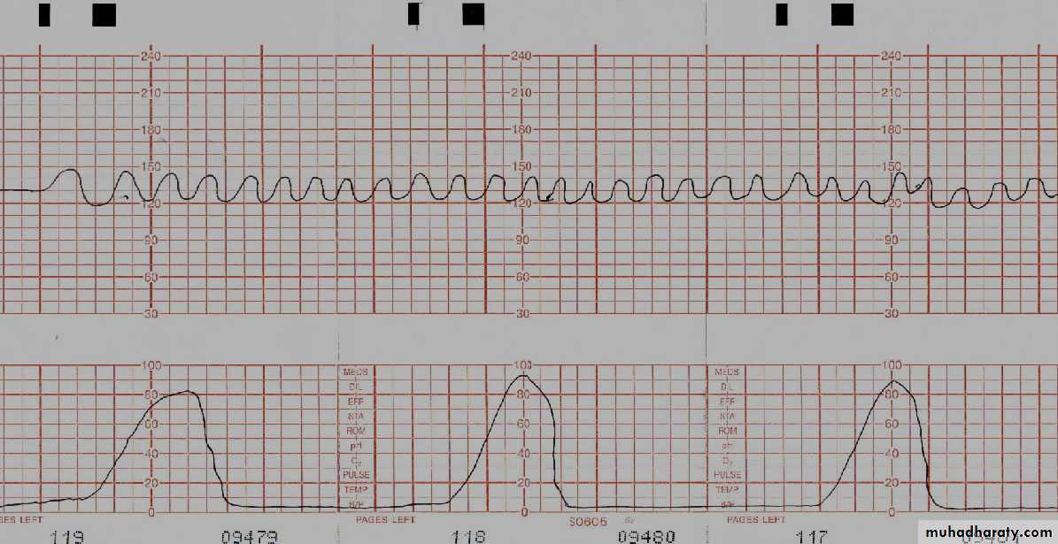 Intrapartum fetal monitoring