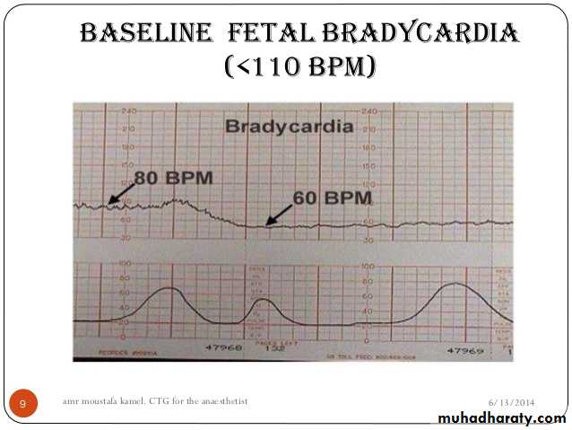 Intrapartum fetal monitoring