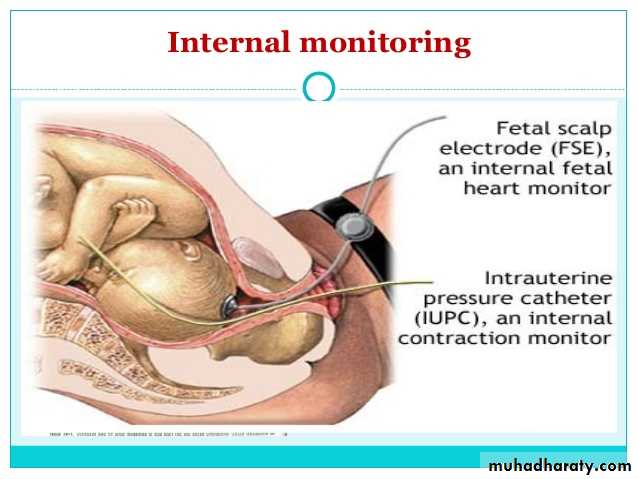 Intrapartum fetal monitoring