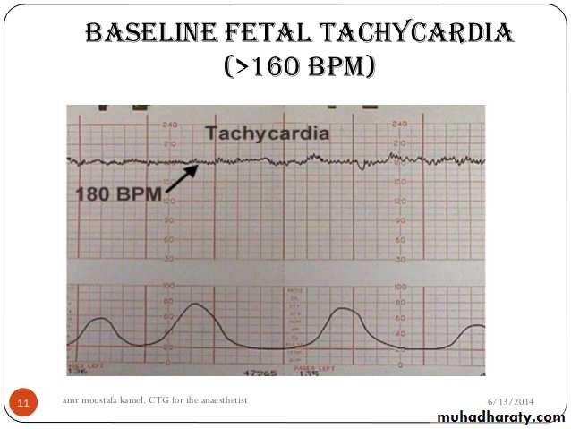 Intrapartum fetal monitoring