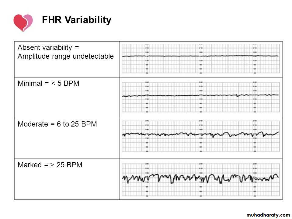 Intrapartum fetal monitoring