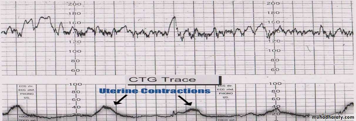Intrapartum fetal monitoring