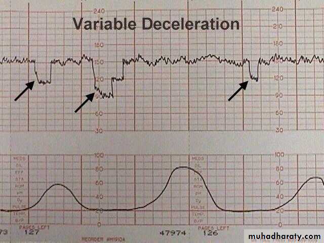 Intrapartum fetal monitoring