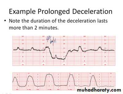 Intrapartum fetal monitoring