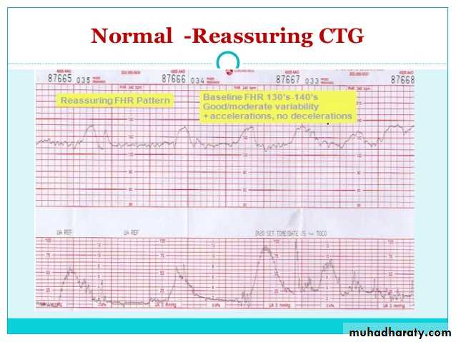 Intrapartum fetal monitoring