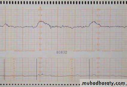 Intrapartum fetal monitoring