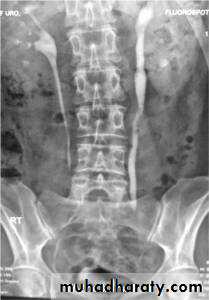 Genitourinary tuberculosis
