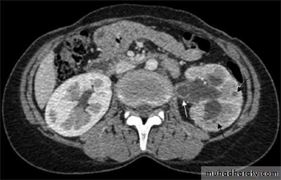 Genitourinary tuberculosis