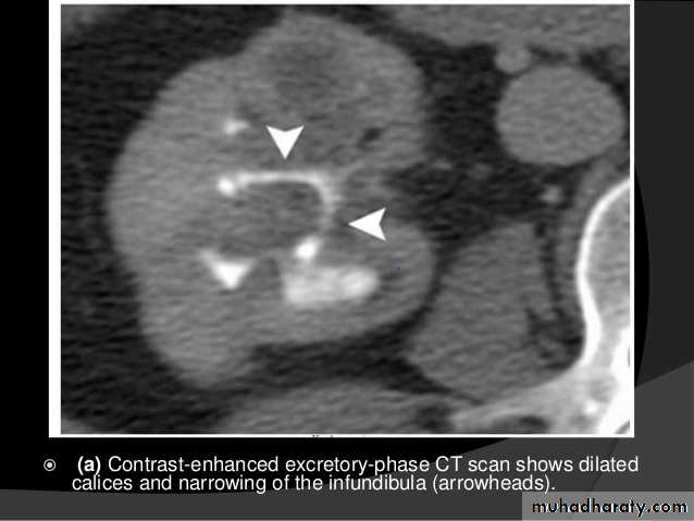 Genitourinary tuberculosis