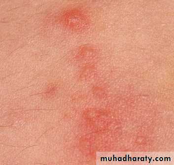 Genitourinary tuberculosis