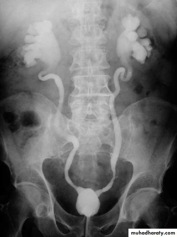Genitourinary tuberculosis
