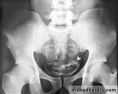 Genitourinary tuberculosis