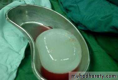 Genitourinary tuberculosis