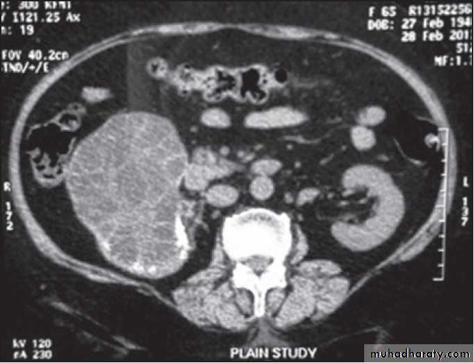 Genitourinary tuberculosis