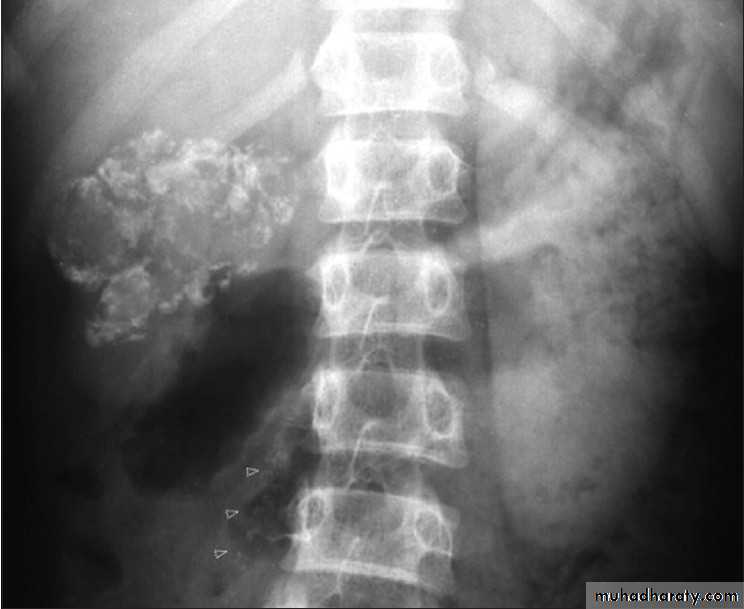 Genitourinary tuberculosis