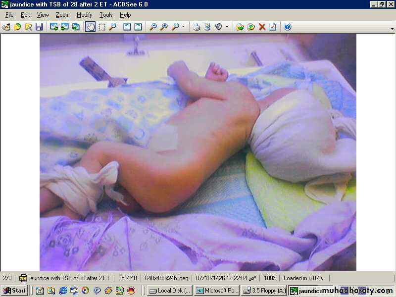 NEONATAL JAUNDICE