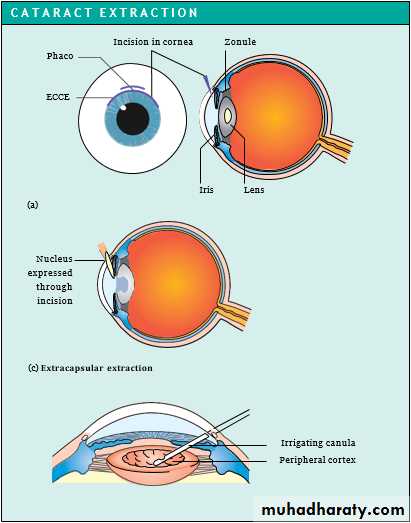 Ophthalmology Lecture Notes