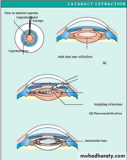 Ophthalmology Lecture Notes