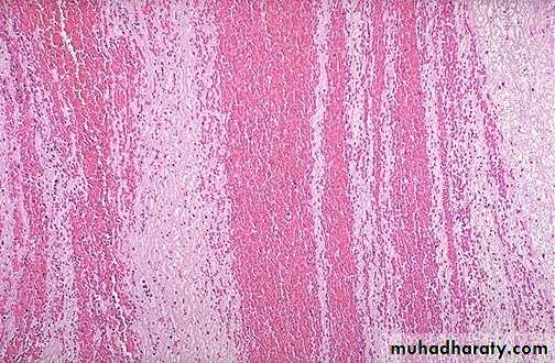Hemodynamic Disorders