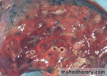 Hemodynamic Disorders