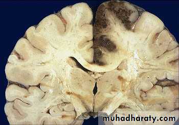 Hemodynamic Disorders