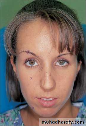 Local Anesthesia