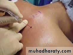 Local Anesthesia