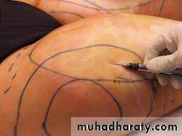 Local Anesthesia