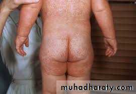 Infectious Disease