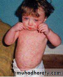 Infectious Disease