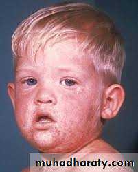 Infectious Disease