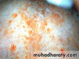 Infectious Disease