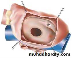 Cardiac Diseases