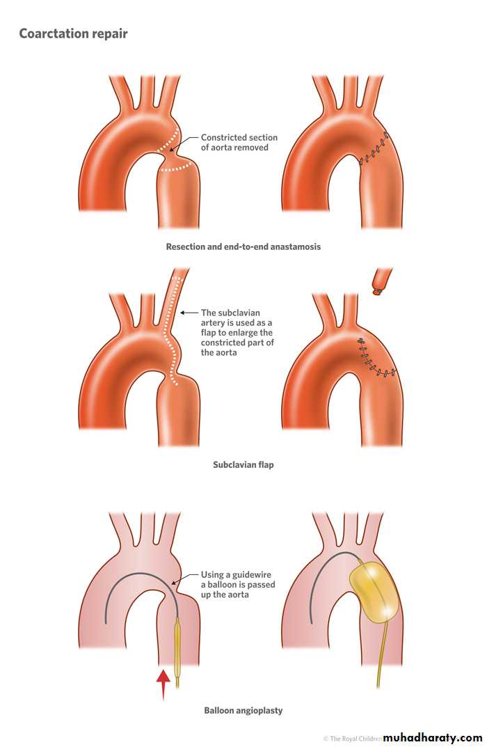 Cardiac Diseases