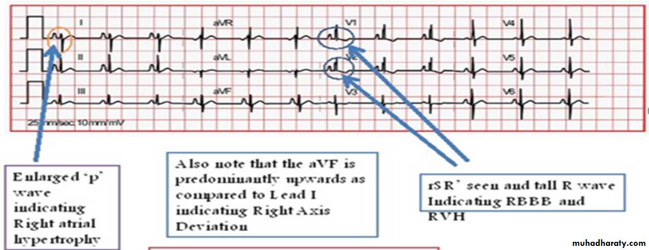 Cardiac Diseases