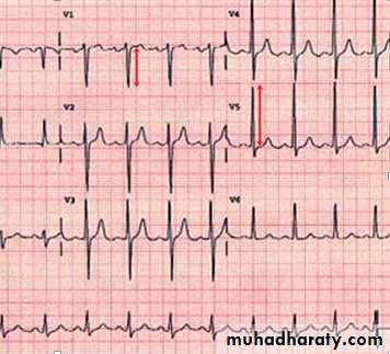 Cardiac Diseases